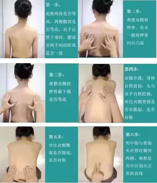 青少年脊柱側彎 昭通李景鏵醫(yī)院有“神器”-昭通李景鏵中醫(yī)骨傷醫(yī)院
