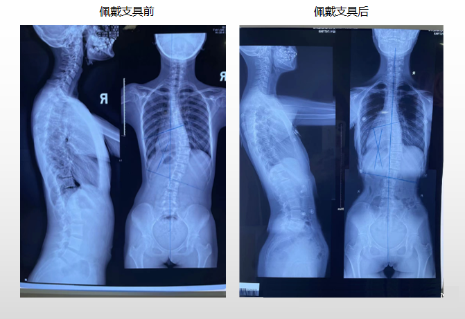 青少年脊柱側彎 昭通李景鏵醫(yī)院有“神器”-昭通李景鏵中醫(yī)骨傷醫(yī)院
