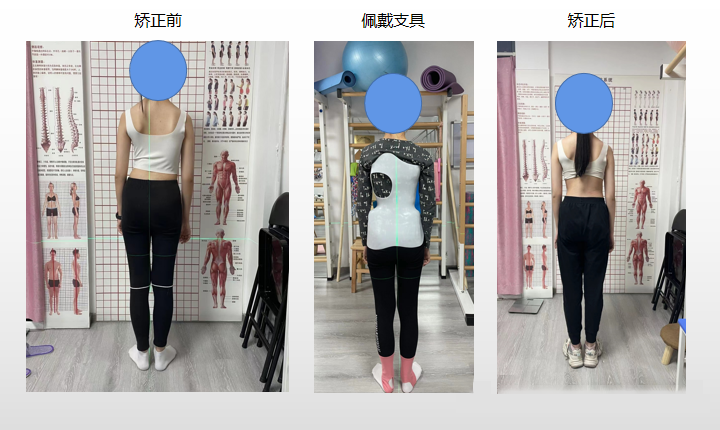 青少年脊柱側彎 昭通李景鏵醫(yī)院有“神器”-昭通李景鏵中醫(yī)骨傷醫(yī)院