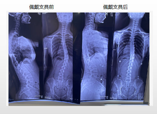 青少年脊柱側彎 昭通李景鏵醫(yī)院有“神器”-昭通李景鏵中醫(yī)骨傷醫(yī)院